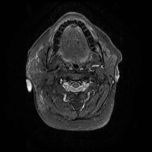 File:Acute otitis externa (Radiopaedia 57296-64236 Axial STIR 15).jpg