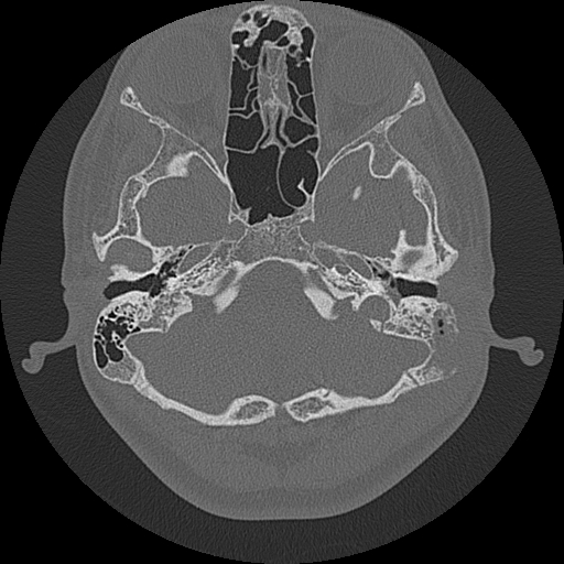 File:Acute otomastoiditis and Bezold abscess (Radiopaedia 88184-104786 Axial bone window 28).jpg