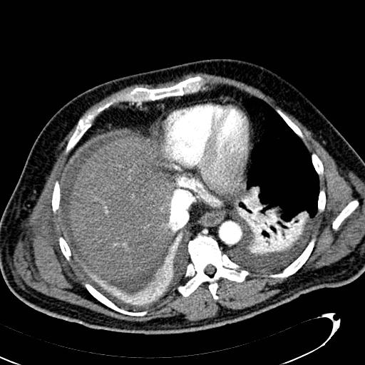 File:Acute pancreatic necrosis (Radiopaedia 13560-13486 Axial C+ portal venous phase 18).jpg