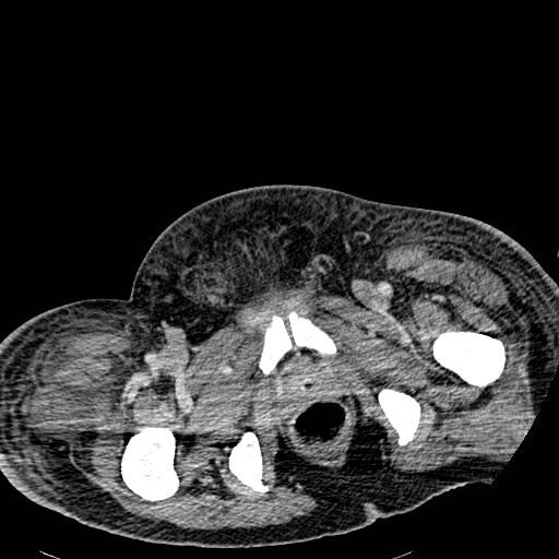 Acute pancreatic necrosis (Radiopaedia 13560-18501 Axial C+ portal venous phase 152).jpg