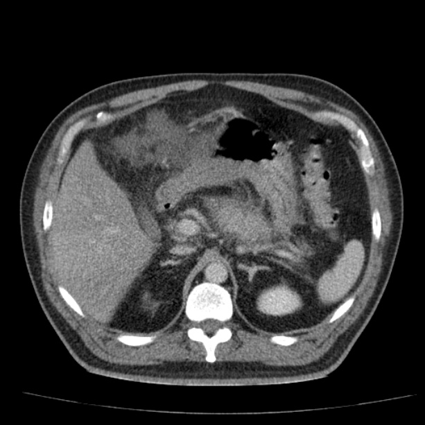 Acute pancreatitis (Radiopaedia 26663-26813 Axial C+ portal venous phase 24).jpg