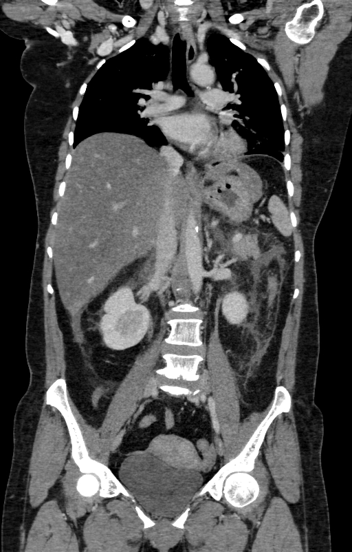 Acute pancreatitis (Radiopaedia 80007-93285 Coronal C+ portal venous phase 68).jpg