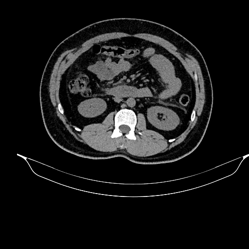 File:Acute pancreatitis (Radiopaedia 87428-103757 Axial non-contrast 46).jpg