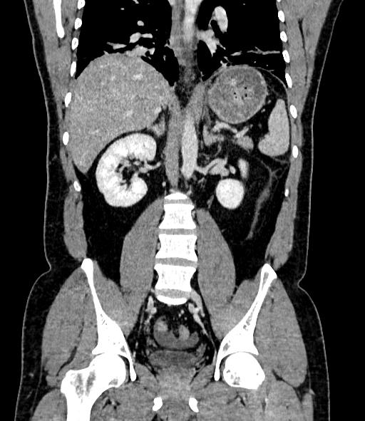 Acute pancreatitis (Radiopaedia 87428-103757 Coronal C+ portal venous phase 57).jpg