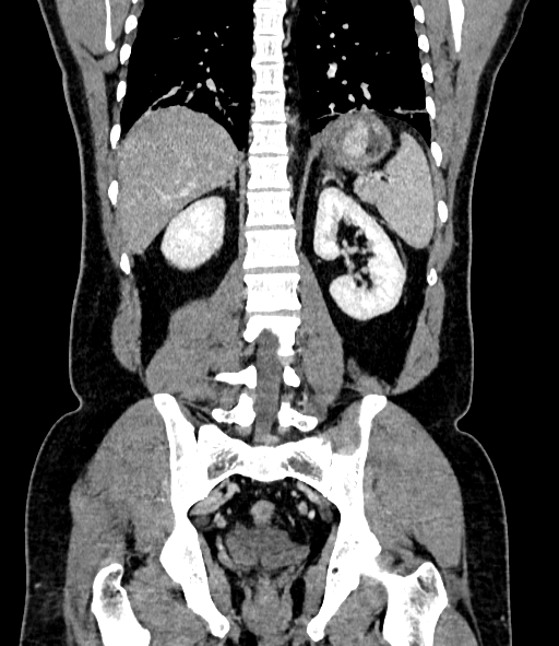 Acute pancreatitis (Radiopaedia 87428-103757 Coronal C+ portal venous phase 66).jpg