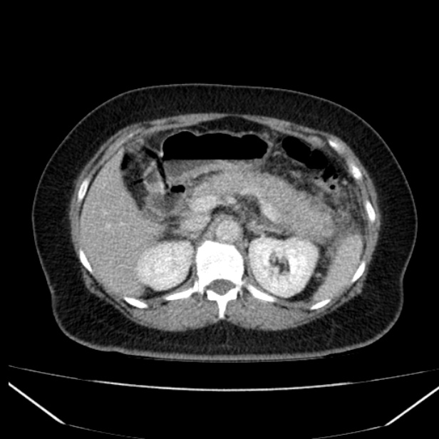 Acute pancreatitis - Balthazar C (Radiopaedia 26569-26714 Axial C+ portal venous phase 36).jpg