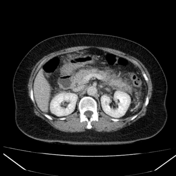 Acute pancreatitis - Balthazar C (Radiopaedia 26569-26714 Axial C+ portal venous phase 39).jpg