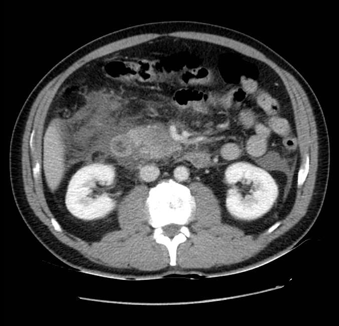 Acute pancreatitis - Balthazar E (Radiopaedia 23080-23110 Axial C+ portal venous phase 31).jpg