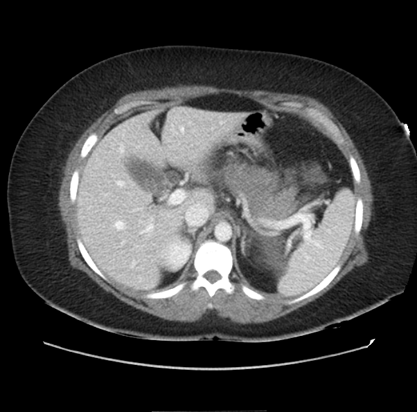Acute pancreatitis - Balthazar E (Radiopaedia 29016-29377 Axial C+ portal venous phase 18).png