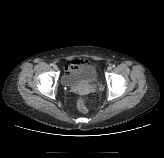 Acute pancreatitis - Balthazar E - post ERCP (Radiopaedia 27562-27772 Axial C+ portal venous phase 71).png