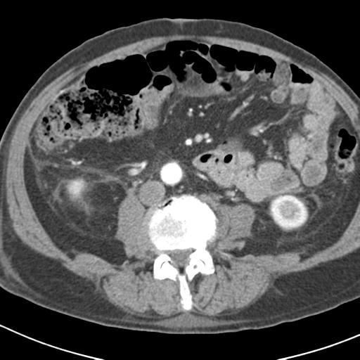 File:Acute pancreatitis and walled-off necrosis (Radiopaedia 29888-30403 Axial C+ portal venous phase 33).jpg