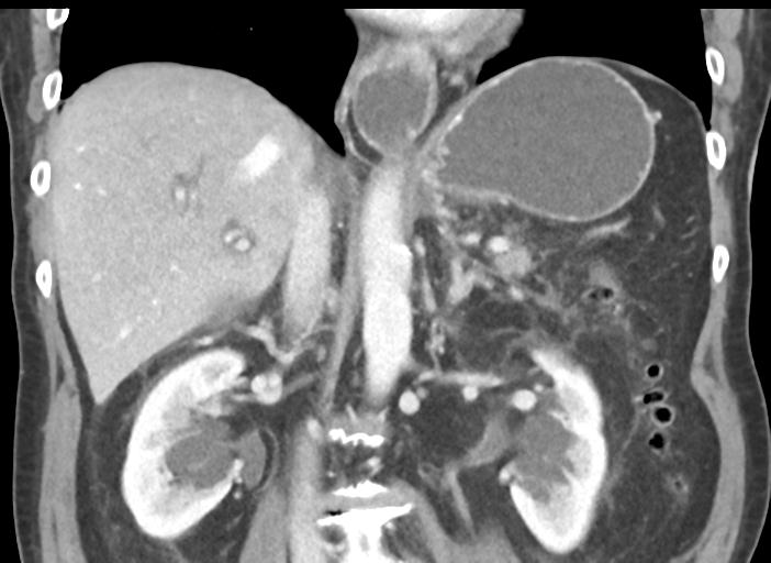 File:Acute pancreatitis and walled-off necrosis (Radiopaedia 29888-30404 Coronal C+ portal venous phase 31).jpg