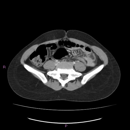 Acute pancreatitis secondary to stone at minor papilla and pancreatic divisum (Radiopaedia 76570-88333 Axial C+ portal venous phase 51).jpg
