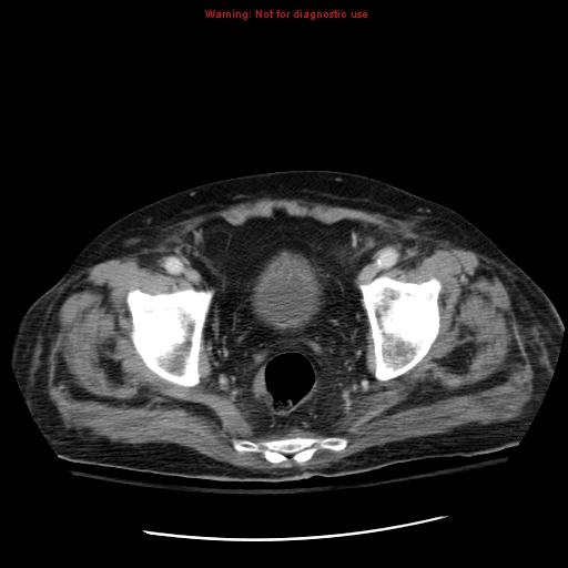 File:Acute pancreatitis with incidental pancreatic lipoma (Radiopaedia 10190-10730 Axial C+ portal venous phase 70).jpg