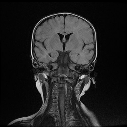 File:Acute phase of hemiconvulsion-hemiplegia epilepsy syndrome (Radiopaedia 29309-29745 Coronal FLAIR 11).jpg