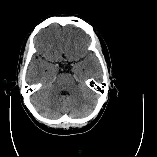 Acute posterior cerebral artery territory infarct (Radiopaedia 79329-92393 Axial non-contrast 33).jpg