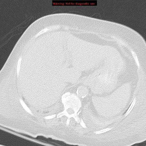 File:Acute pulmonary embolism (Radiopaedia 13286-13289 B 38).jpg
