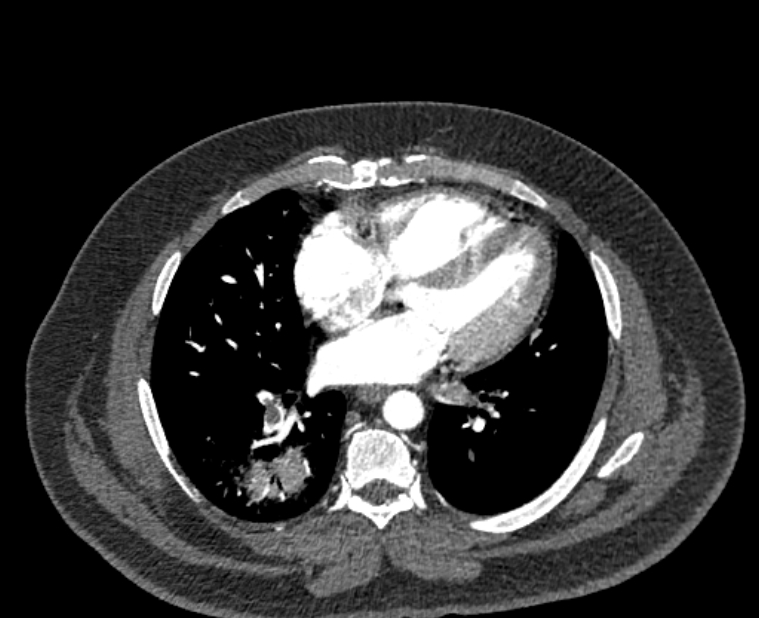 Acute pulmonary embolism with pulmonary infarcts (Radiopaedia 77688-89908 Axial C+ CTPA 39).jpg