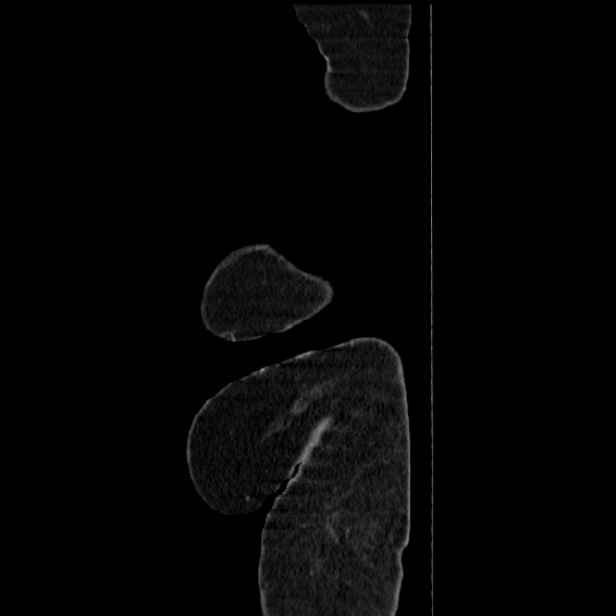 Acute pyelonephritis (Radiopaedia 25657-25837 Sagittal renal parenchymal phase 81).jpg