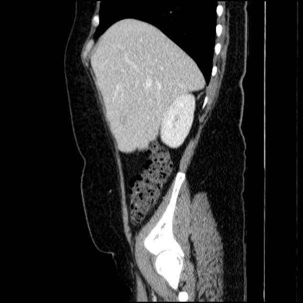 Acute pyelonephritis (Radiopaedia 33397-34434 Sagittal renal parenchymal phase 24).jpg