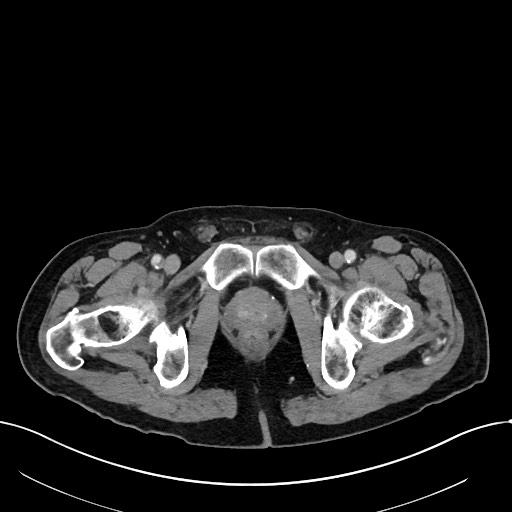 Acute renal infarction (Radiopaedia 59375-66736 Axial C+ portal venous phase 120).jpg