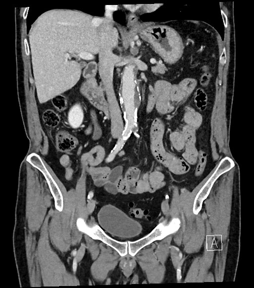 File:Acute renal infarction (Radiopaedia 59375-66736 Coronal C+ portal venous phase 30).jpg