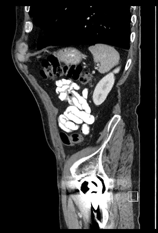 Acute renal infarction - rim capsular enhancement (Radiopaedia 59833-67270 Sagittal C+ portal venous phase 21).jpg