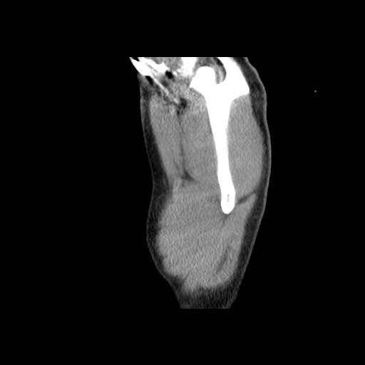 Acute segmental pulmonary emboli and pulmonary infarction (Radiopaedia 62264-70444 Sagittal C+ CTPA 64).jpg