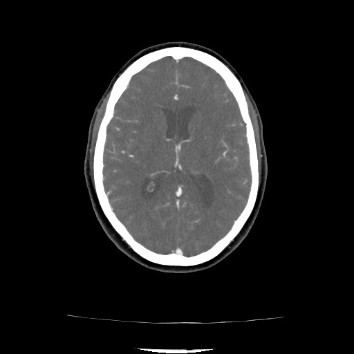 File:Acute subarachnoid hemorrhage and accessory anterior cerebral artery (Radiopaedia 69231-79009 Axial C+ arterial phase 101).jpg