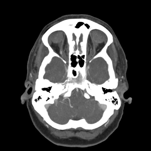 Acute subarachnoid hemorrhage and accessory anterior cerebral artery (Radiopaedia 69231-79009 D 17).jpg