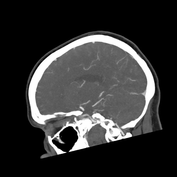 Acute subarachnoid hemorrhage and accessory anterior cerebral artery (Radiopaedia 69231-79009 Sagittal C+ arterial phase 31).jpg