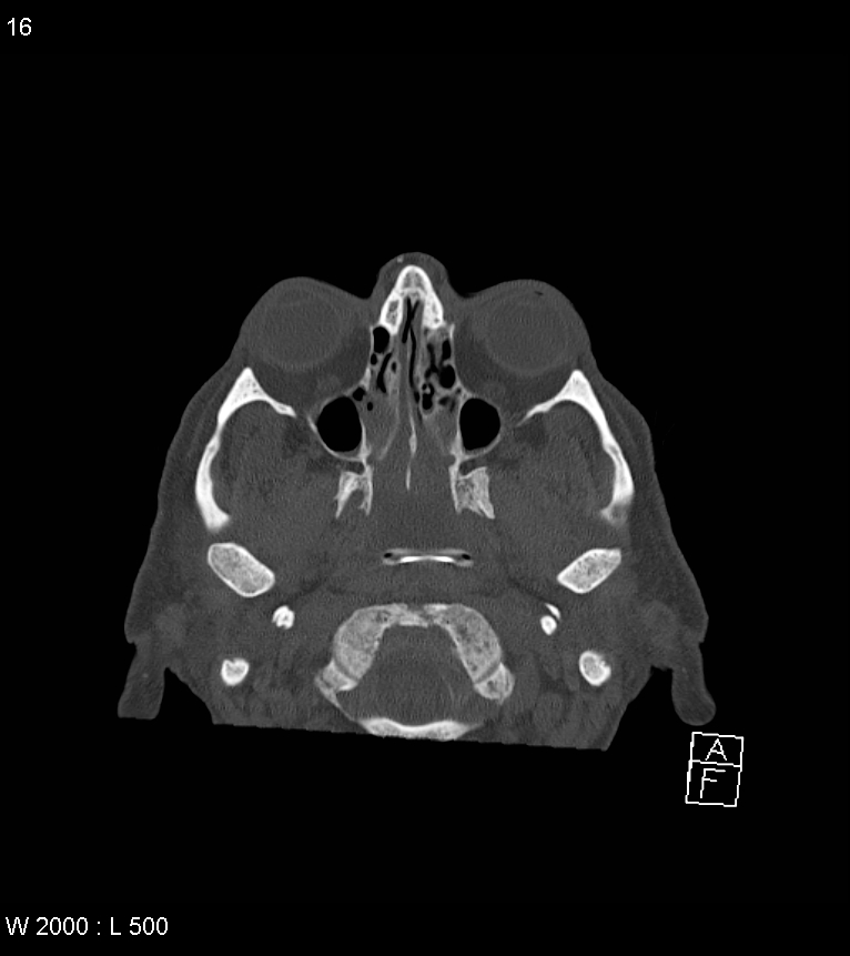 Acute subdural hematoma with myelofibrosis (Radiopaedia 52582-58494 Axial bone window 8).jpg