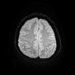 Acute superior cerebellar artery territory infarct (Radiopaedia 84104-99358 Axial DWI 10).jpg