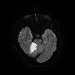 Acute superior cerebellar artery territory infarct (Radiopaedia 84104-99358 Axial DWI 55).jpg