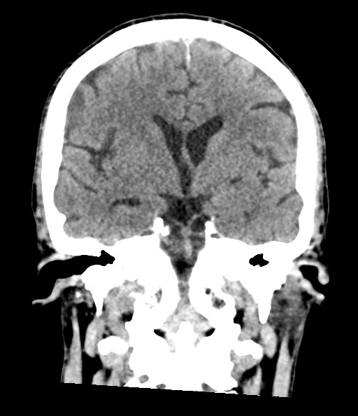 Acute superior cerebellar artery territory infarct (Radiopaedia 84104-99359 Coronal non-contrast 49).jpg