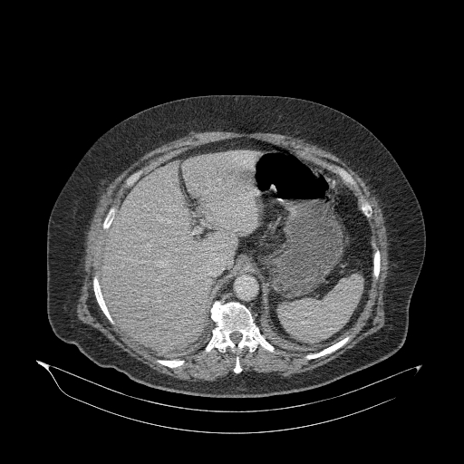 File:Acute superior mesenteric artery occlusion (Radiopaedia 51288-56960 Axial C+ portal venous phase 22).jpg