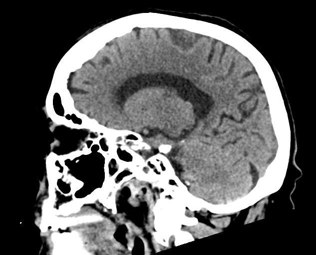 Acute traumatic subdural hematoma (Radiopaedia 82921-97257 Sagittal non-contrast 45).jpg