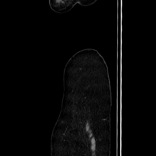 Acute uncomplicated appendicitis (Radiopaedia 73704-84499 Sagittal C+ portal venous phase 27).jpg
