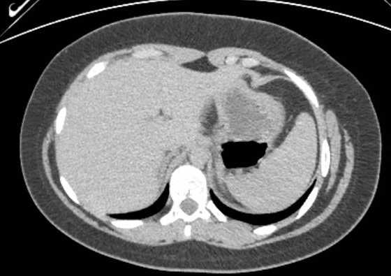 File:Acute unilateral nonhemorrhagic adrenal infarction (Radiopaedia 67560-76957 Axial renal excretory phase 11).jpg