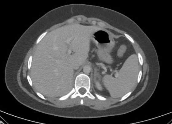File:Acute unilateral nonhemorrhagic adrenal infarction (Radiopaedia 67560-76957 Axial renal parenchymal phase 14).jpg