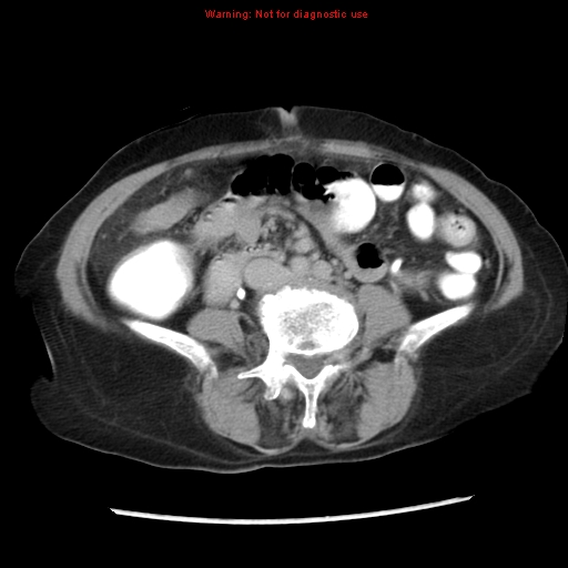 Adenocarcinoma of the colon (Radiopaedia 8191-9039 Axial renal excretory phase 31).jpg