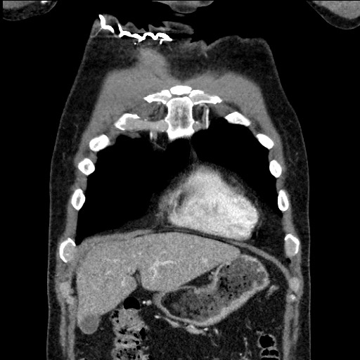 Adenocarcinoma of the lung (Radiopaedia 59871-67325 Coronal C+ arterial phase 10).jpg