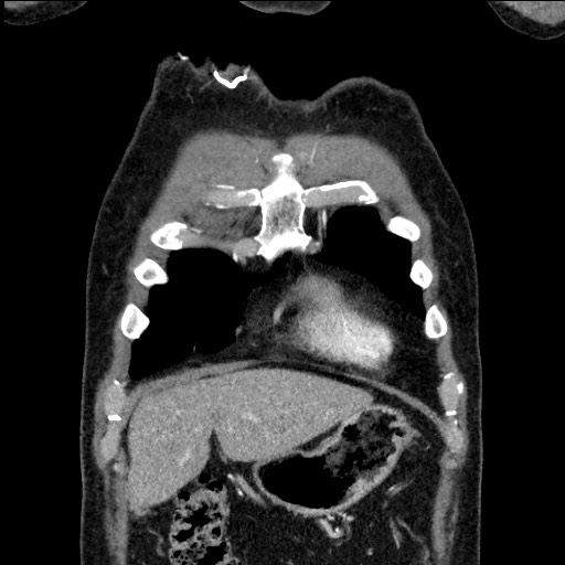 Adenocarcinoma of the lung (Radiopaedia 59871-67325 Coronal C+ arterial phase 8).jpg