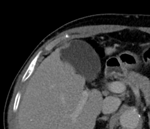 File:Adenomyomatosis of the gallbladder (Radiopaedia 14447-14387 Axial C+ portal venous phase 1).jpg