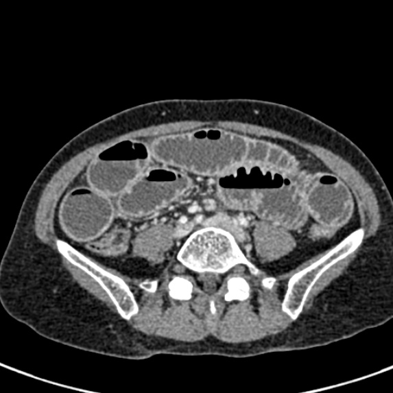 Adhesional small bowel obstruction (Radiopaedia 48397-53305 Axial C+ portal venous phase 59).jpg