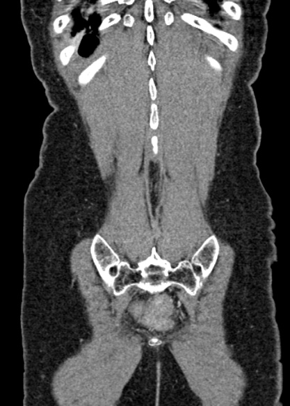 Adhesional small bowel obstruction (Radiopaedia 48397-53305 Coronal C+ portal venous phase 313).jpg