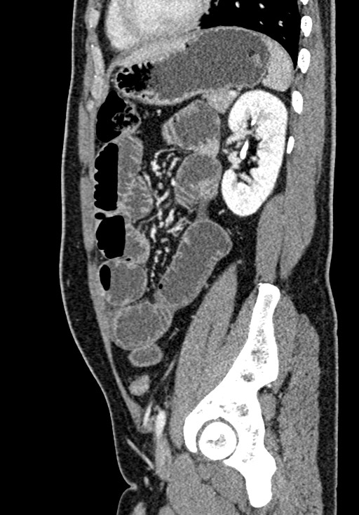Adhesional small bowel obstruction (Radiopaedia 58900-66131 Sagittal C+ portal venous phase 177).jpg