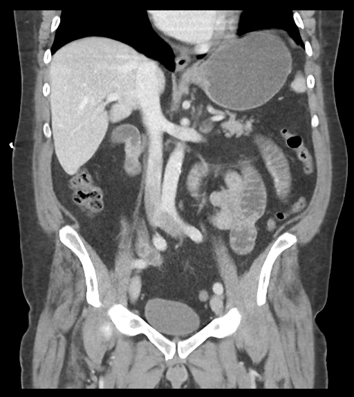 Adhesions within abdominal wall hernia (Radiopaedia 58283-65394 Coronal C+ portal venous phase 38).png