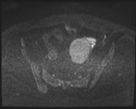 Adnexal multilocular cyst (O-RADS US 3- O-RADS MRI 3) (Radiopaedia 87426-103754 Axial DWI 69).jpg