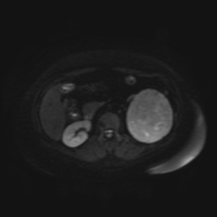 Adrenal cortical carcinoma (Radiopaedia 70906-81116 Axial DWI 15).jpg